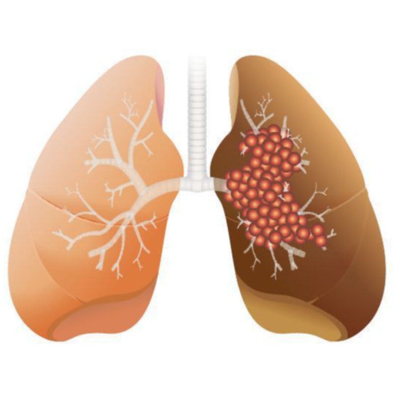 Liều cao NMN ức chế sự phát triển của ung thư biểu mô tuyến phổi